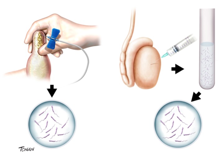 Testicular Sperm Extraction (TESE)