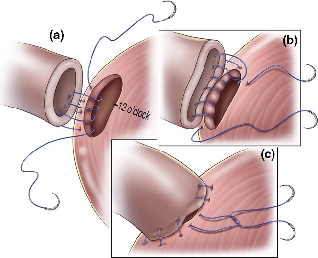 6- ANASTOMOSE ENTRE A BEXIGA E URETRA