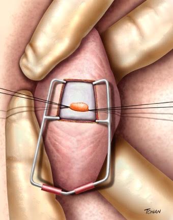 Microsurgical Epididymal Sperm Aspiration – MESA