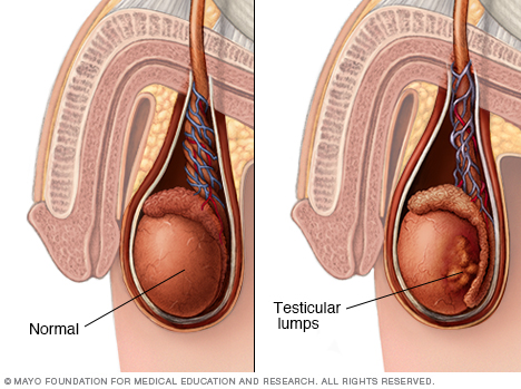 genes cancer testicular 1