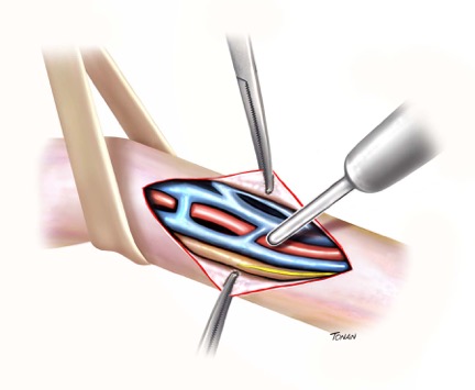 varicocele