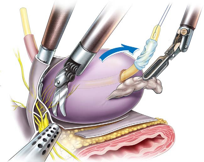 DISSECÇÃO DO FEIXE DE NERVOS ERIGENTES