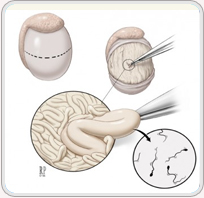 oligospermia 1