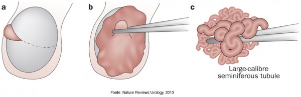 oligospermia 2