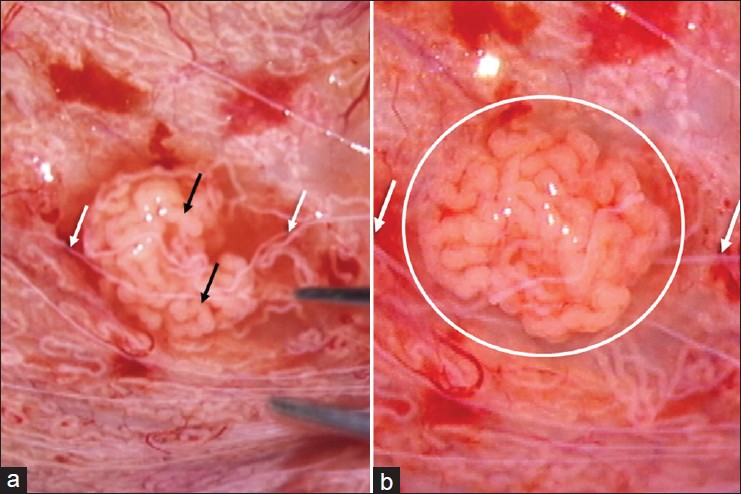 oligospermia 3