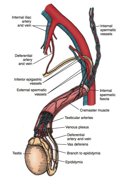 varicocele