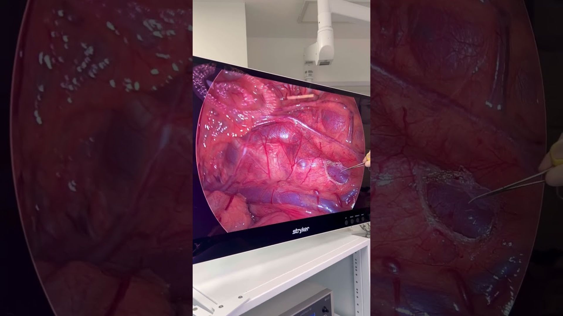 Ligadura alta da veia gonadal próximo da veia renal esquerda para síndrome de nutcracker!