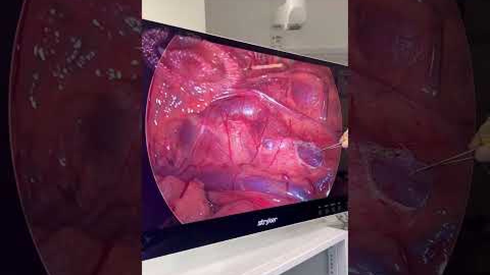 Ligadura alta da veia gonadal próximo da veia renal esquerda para síndrome de nutcracker!